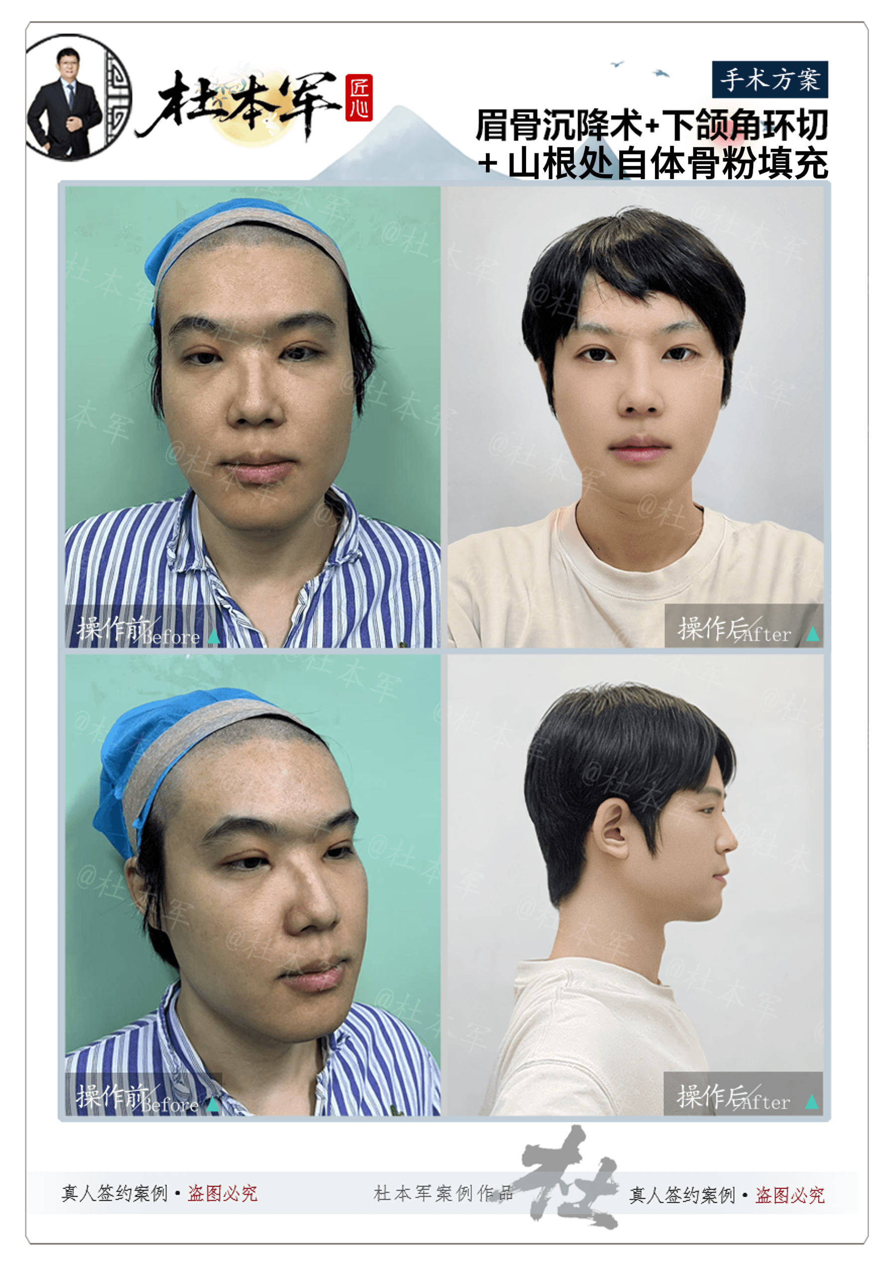 Selected transfeminine facial feminization case