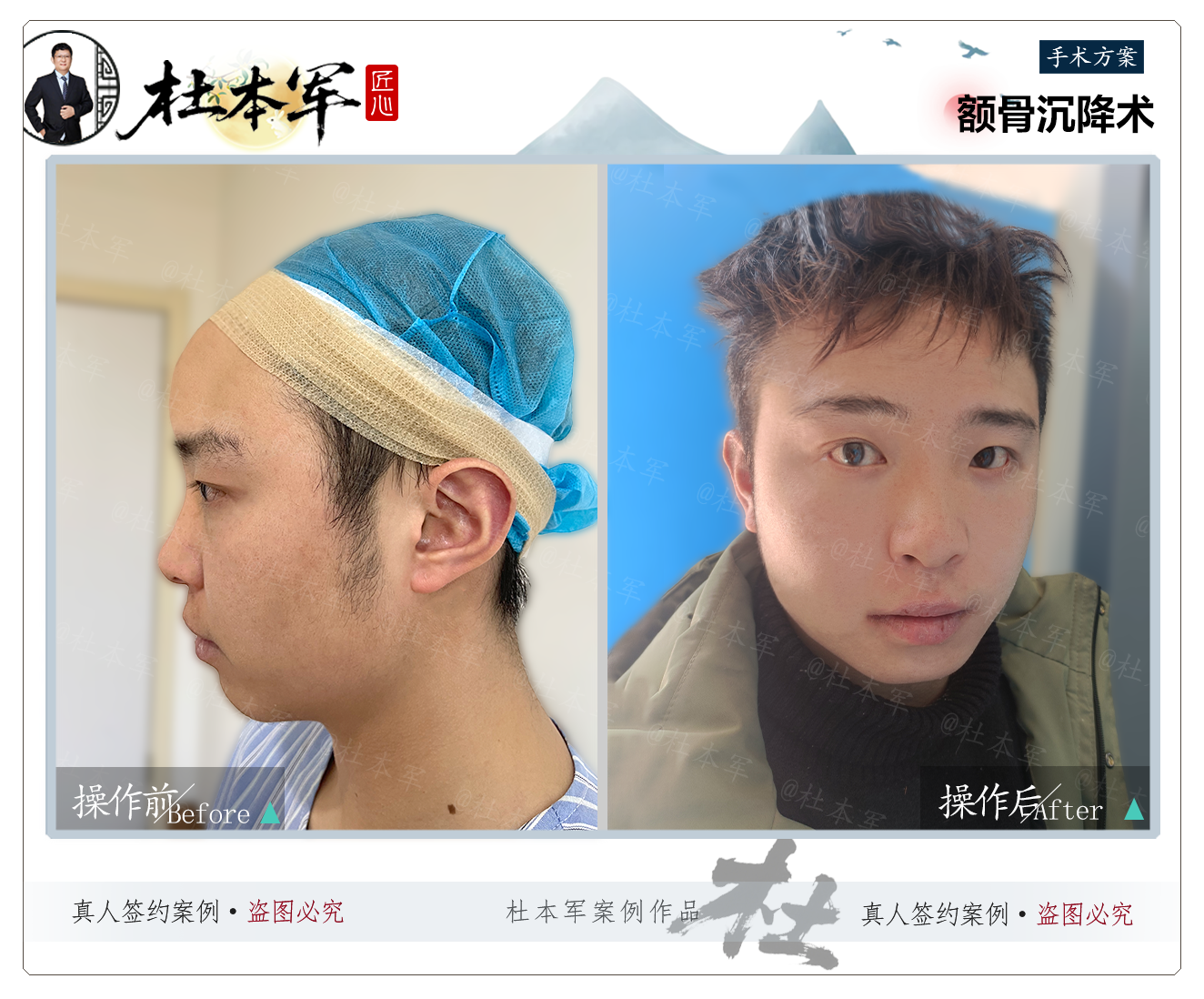 Upper-face feminization case